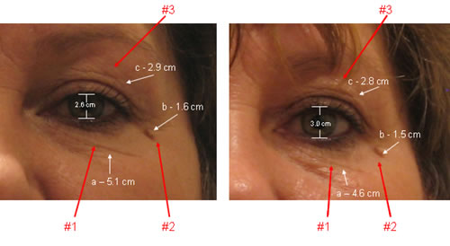 Eye lifting surgery
