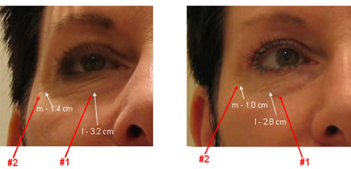 Eye lifting surgery